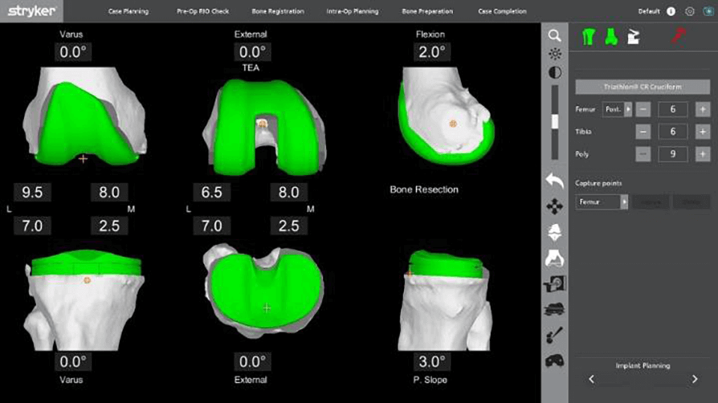 Prothèse Totale de Genou (PTG) par assistance robotique MAKO